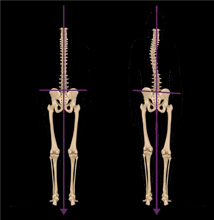 Plaatje van twee skeletten, waarvan 1 een scheef bekken heeft
